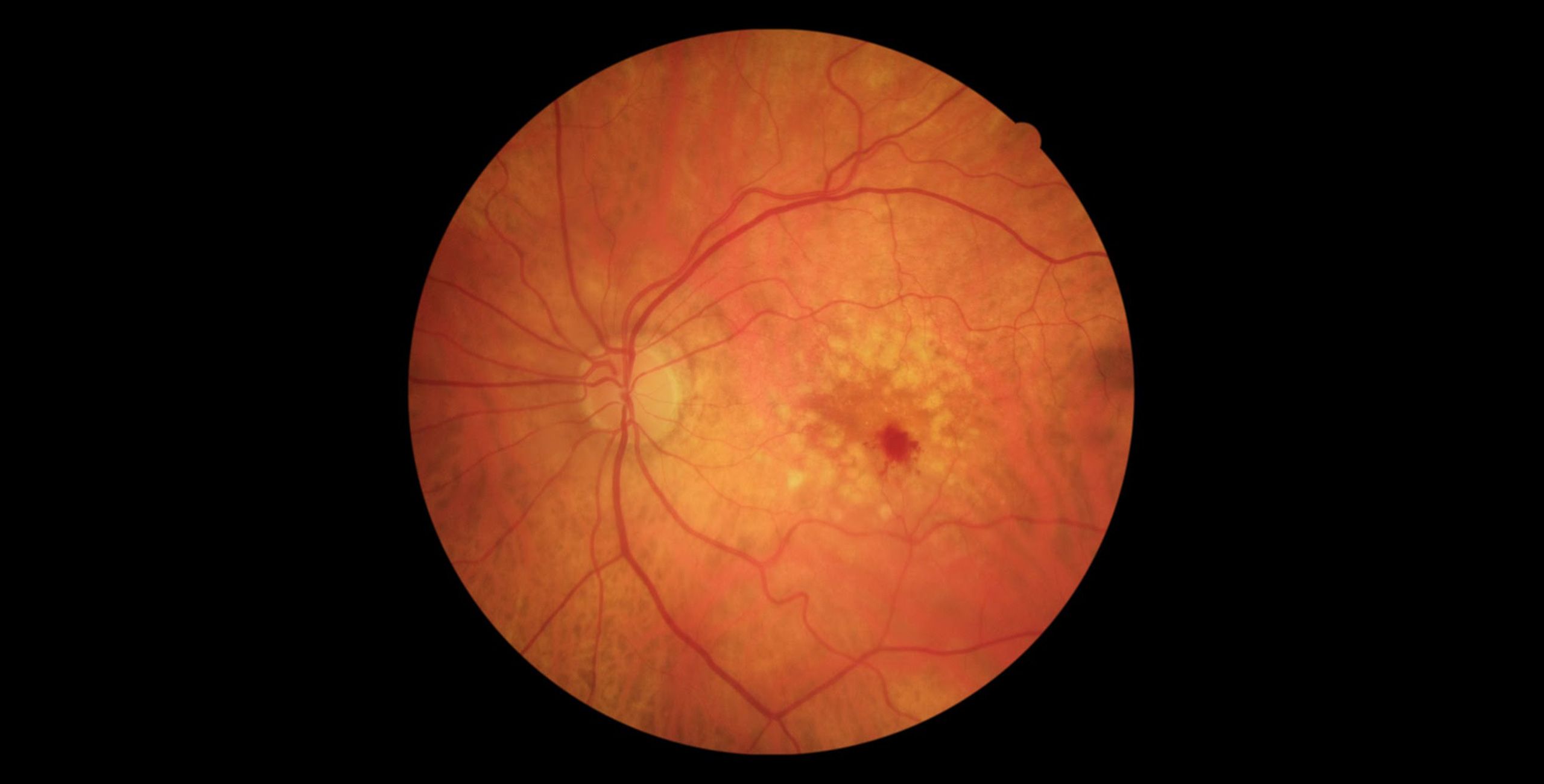 degenerescence maculaire liee a l age dmla centre ophtalmologique