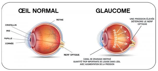 Glaucome : 4 signes qui doivent vous alerter